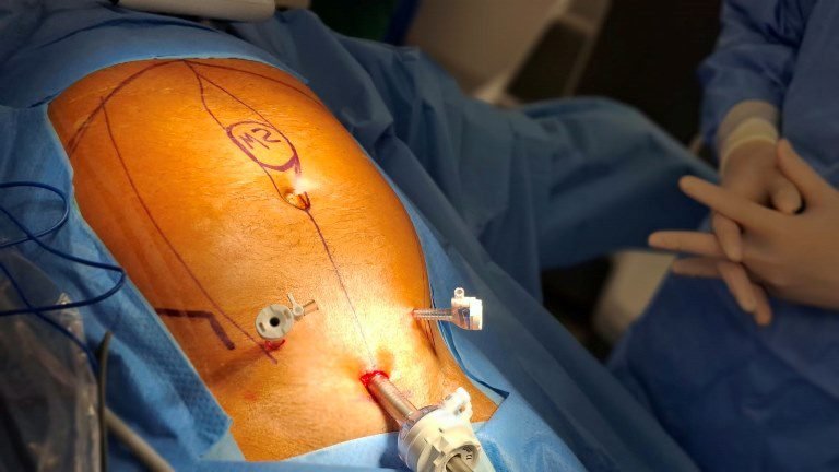 Ciudad de la Salud incorpora técnica PeTEP para hernias